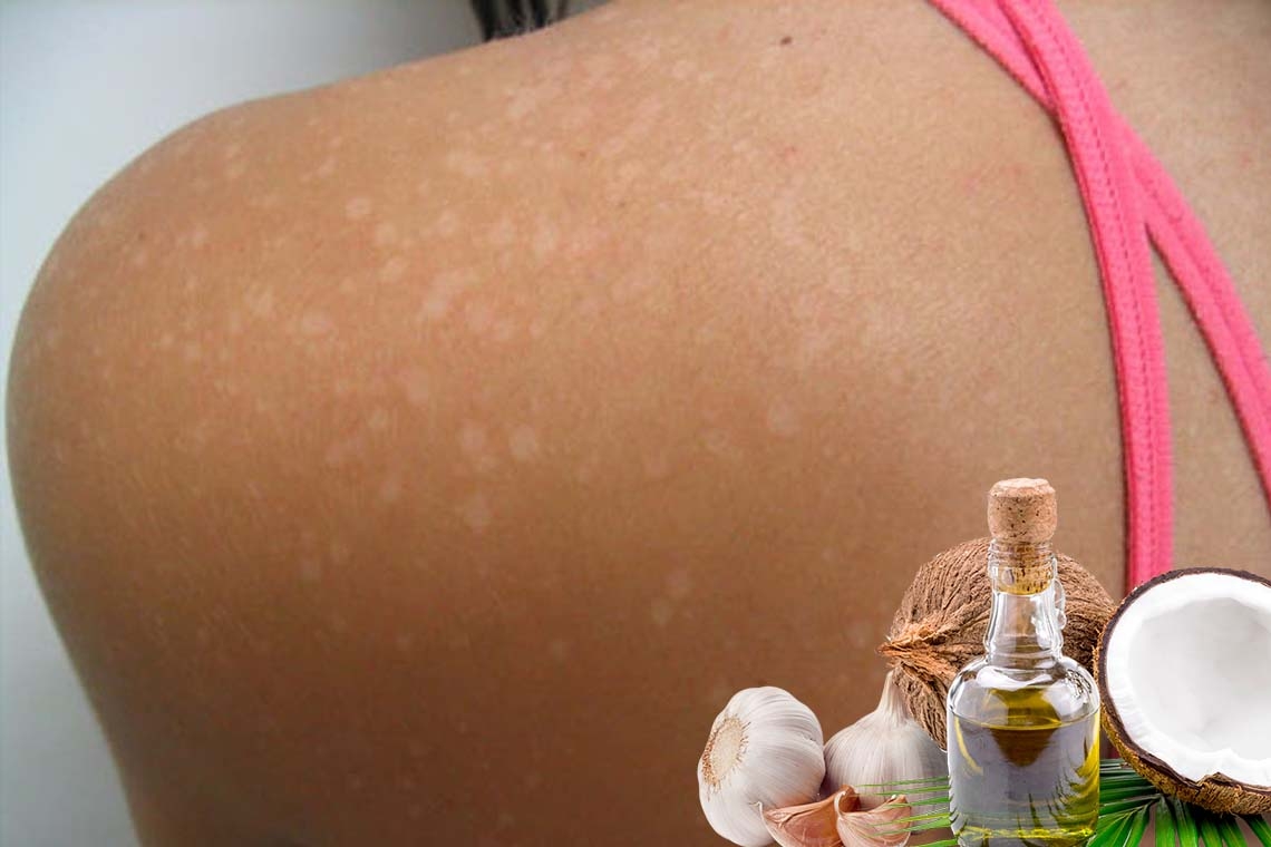 Le pityriasis : L’ail et l’huile de coco à la rescousse